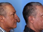 Hombre con deformidad en su nariz recibió cirugía como regalo navideño