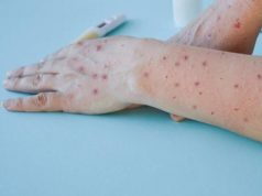 Veracruz confirma su primer caso de viruela del mono