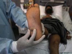 Viruela del mono en México: Secretaría de Salud confirma 788 casos