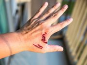 Reportan graves a dos menores por mordidas de murciélago en Oaxaca