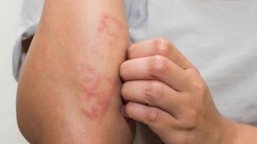 Incrementan casos de lepra en México: Ssa