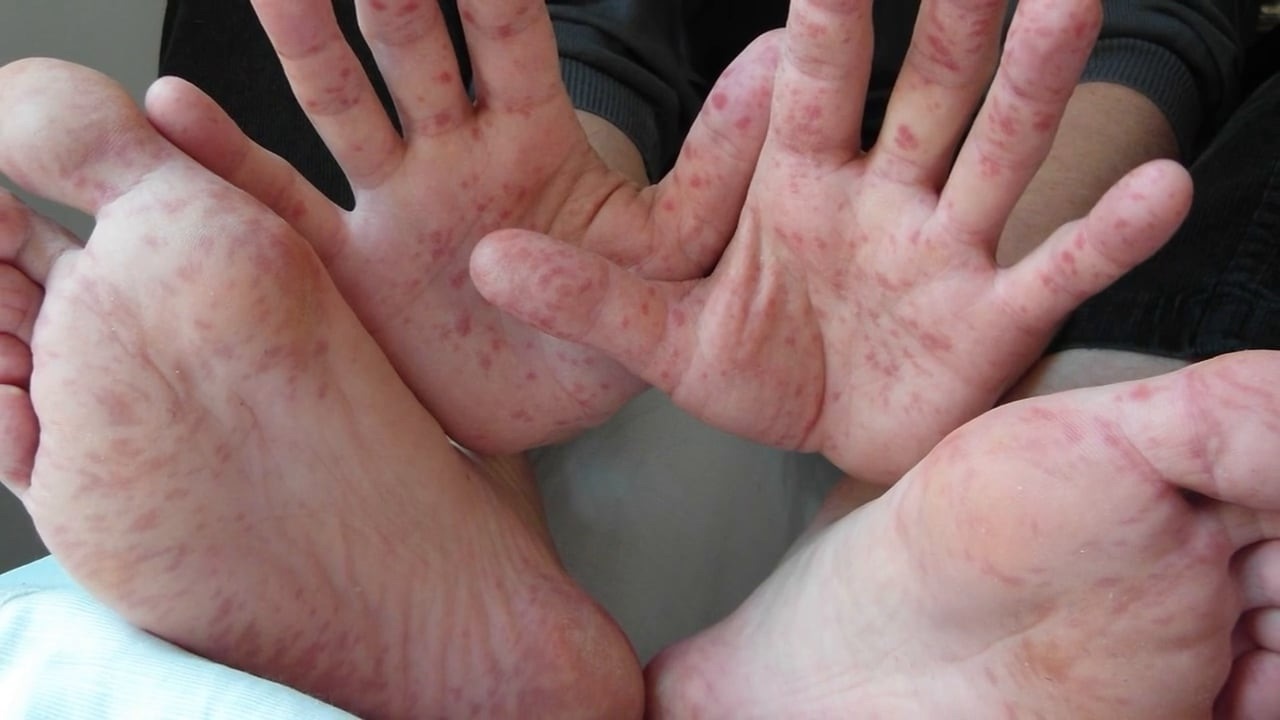 17 niños en Puebla afectados por virus Coxsackie; escuelas en alerta